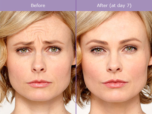 BOTOX Cosmetic for Facial Rejuvenation | InFocus Eye Care