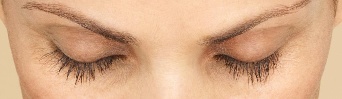 Latisse - After | InFocus Eye Care